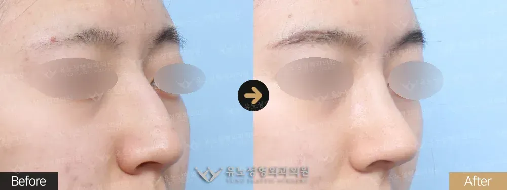 복코교정 · 매부리교정 전후사진 45도 - 유노성형외과