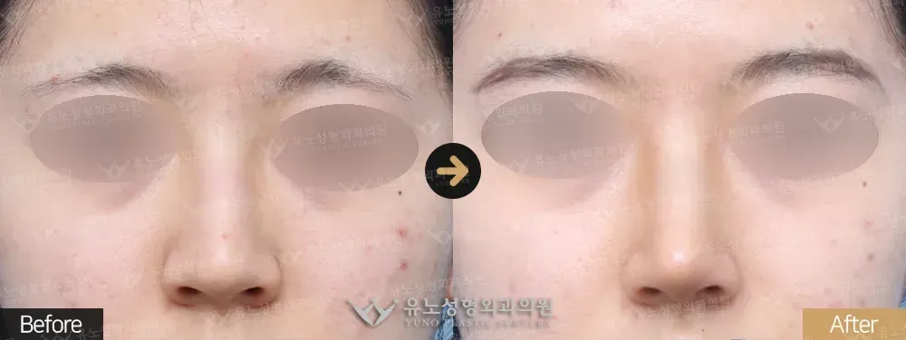 복코교정 · 매부리교정 전후사진 정면 - 유노성형외과