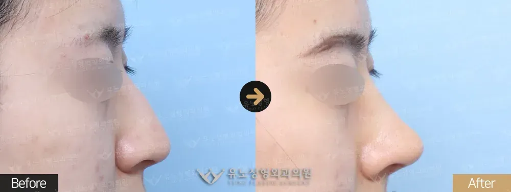 복코교정 · 매부리교정 전후사진 측면 - 유노성형외과
