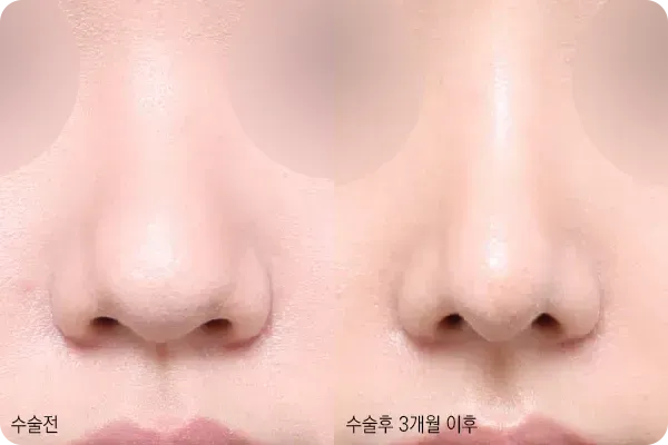 복코성형으로 날렵해진 코끝