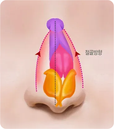 휜코 · 기능코성형 과정 - 수술 전
