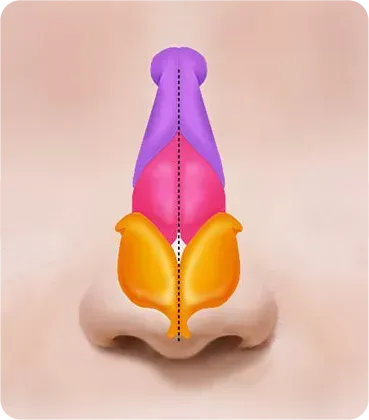 휜코 · 기능코성형 과정 - 수술 후