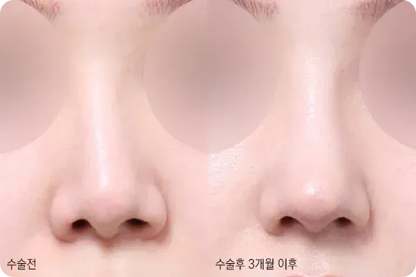 휜코성형으로 중심을 맞춘 코