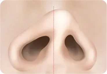 휜코 · 기능코성형 과정 - 수술 전