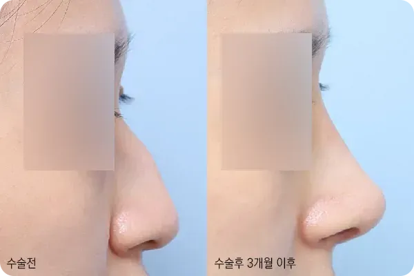 매부리코성형으로 매끈해진 콧등 라인