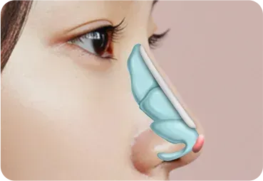 매부리코성형 과정 - 보형물·자가조직으로 라인 보완