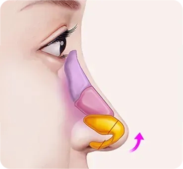 긴코 · 화살코성형 과정 - 3. 남은 연골을 위로 들어 봉합