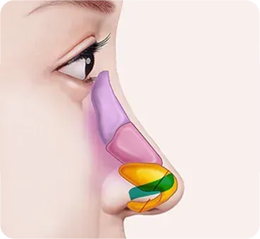 긴코 · 화살코성형 과정 - 4. 비중격 연장으로 방향 고정