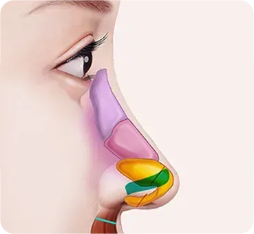 긴코 · 화살코성형 과정 - 5. 코끝 내림근 절제로 재발 방지