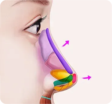 긴코 · 화살코성형 과정 - 6. 필요 시 콧대·코끝 높이 보완