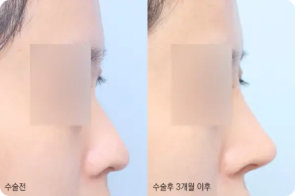 낮은코성형으로 입체감을 더한 옆모습