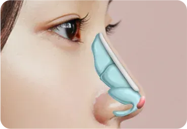 낮은코성형 과정 - 콧대 보형물 + 코끝 자가연골