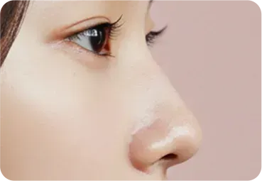 낮은코성형 과정 - 수술 후