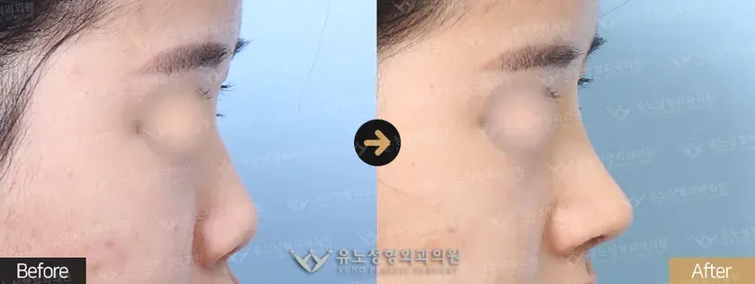 유노성형외과 유노 리버스코성형 관련 전후사진 - 융비술