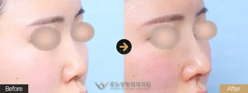 유노성형외과 유노 리버스코성형 관련 전후사진 - 짧은코 교정