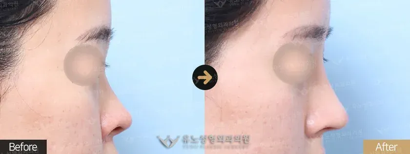 유노성형외과 유노 리버스코성형 관련 전후사진 - 융비술, 짧은코, 복코