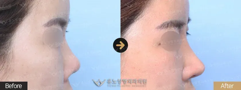 유노성형외과 코재수술 관련 전후사진 - 코재수술, 짧은코교정
