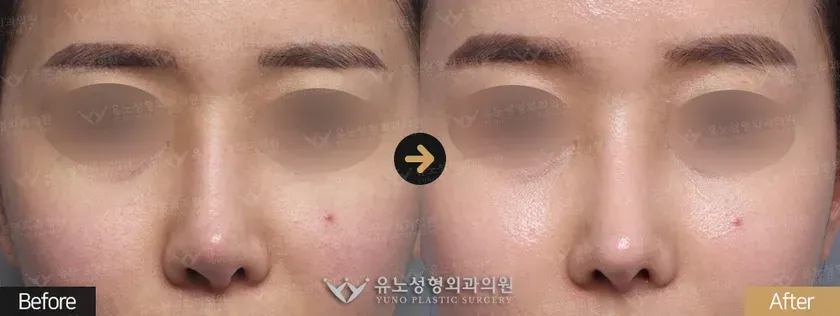 유노성형외과 휜코 · 기능코성형 관련 전후사진 - 코재수술, 콧구멍 비대칭 개선, 휜코교정
