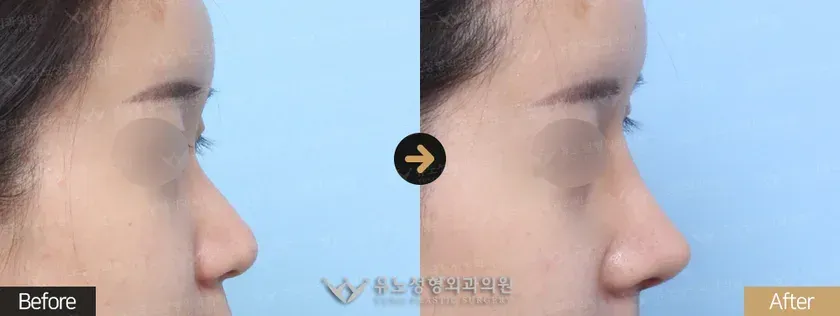 유노성형외과 낮은코성형 관련 전후사진 - 낮은코성형, 복코교정