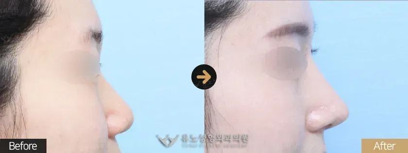 유노성형외과 낮은코성형 관련 전후사진 - 코성형, 복코