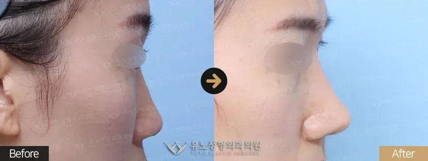 유노성형외과 낮은코성형 관련 전후사진 - 낮은코성형, 매부리교정, 복코
