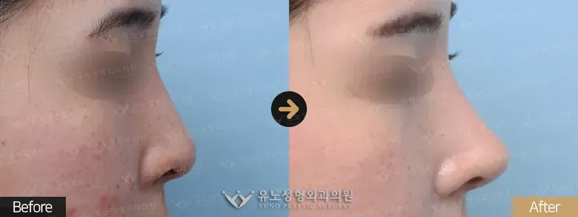 유노성형외과 낮은코성형 관련 전후사진 - 복코교정