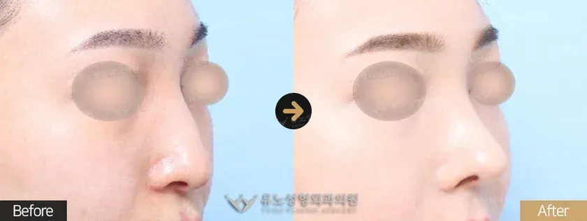 유노성형외과 긴코 · 화살코성형 관련 전후사진 - 코끝수술, 매부리교정, 절골, 긴코교정