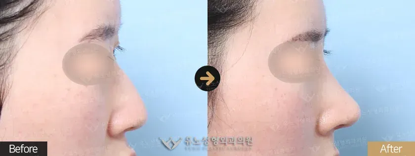 유노성형외과 매부리코성형 관련 전후사진 - 융비술, 매부리교정, 절골