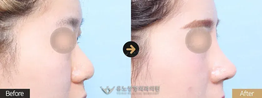유노성형외과 복코성형 관련 전후사진 - 융비술, 복코교정