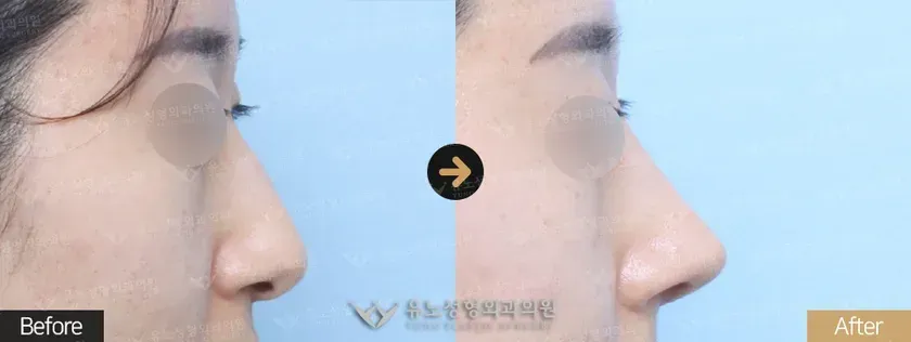 유노성형외과 긴코 · 화살코성형 관련 전후사진 - 긴코교정, 매부리교정