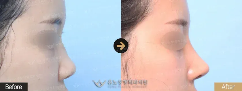 유노성형외과 짧은코성형 관련 전후사진 - 코성형, 짧은코 교정, 복코