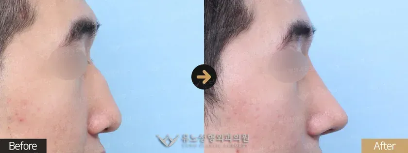 유노성형외과 긴코 · 화살코성형 관련 전후사진 - 남자코성형, 매부리교정, 긴코교정