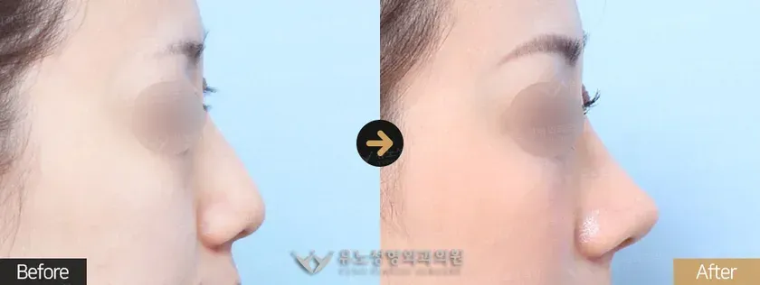 유노성형외과 휜코 · 기능코성형 관련 전후사진 - 코끝성형, 매부리교정, 긴코, 절골, 휜코