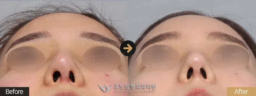 유노성형외과 휜코 · 기능코성형 관련 전후사진 - 코재수술, 콧구멍 비대칭 개선, 휜코교정