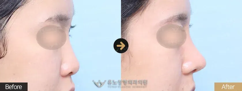 유노성형외과 복코성형 관련 전후사진 - 복코교정, 입매교정