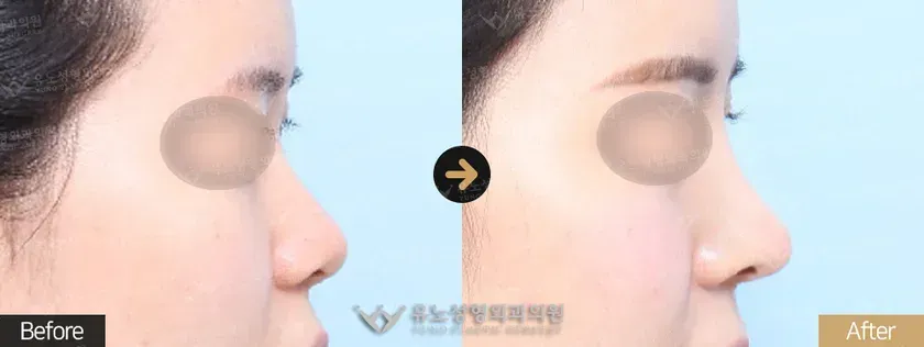 유노성형외과 복코성형 관련 전후사진 - 융비술, 복코