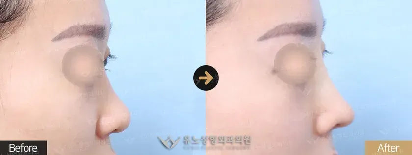 유노성형외과 복코성형 관련 전후사진 - 융비술, 복코
