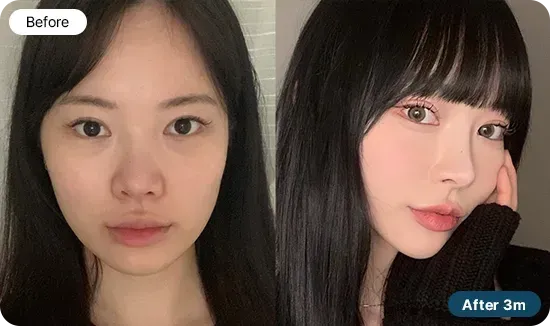 유노성형외과 코재수술 상담과 계획