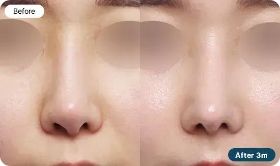 코재수술 유형 - 코끝이 휘거나 비주가 한쪽으로 기운 경우