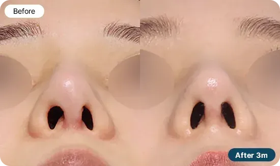 코재수술 유형 - 콧구멍 모양이 비대칭인 경우