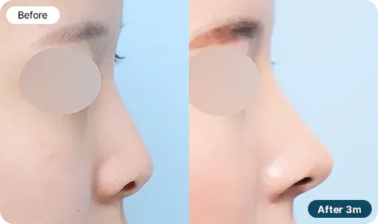 코재수술 유형 - 코가 짧은 경우