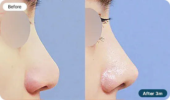 코재수술 유형 - 콧대가 높고 코가 들린 경우