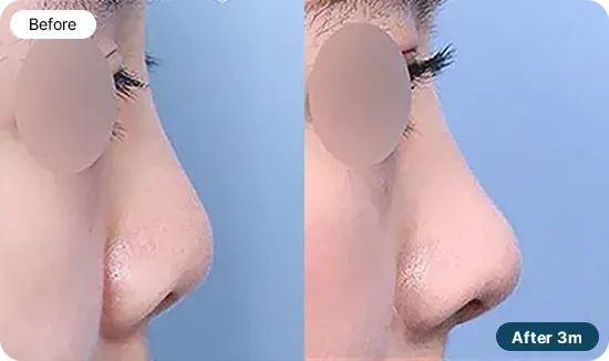 코재수술 유형 - 콧구멍 비대칭과 찝힌코가 함께 있는 경우