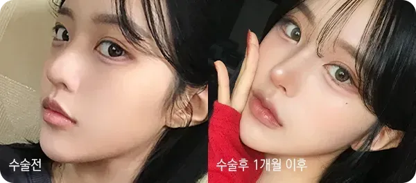 유노성형외과 코성형 전후 사진 1