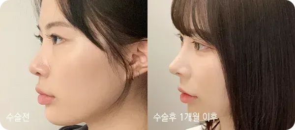 유노성형외과 코성형 전후 사진 2