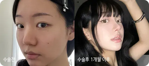 유노성형외과 코성형 전후 사진 3