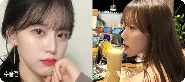 유노성형외과 코성형 전후 사진 4