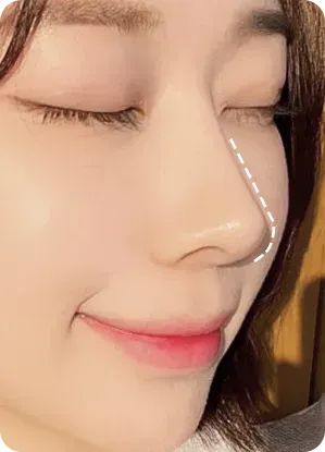 직선 코라인 예시 - 콧대부터 코끝까지 곧은 라인