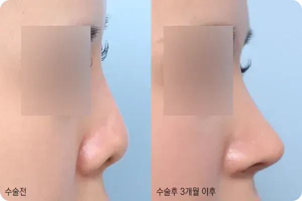 짧은코성형으로 길이를 맞춘 코라인
