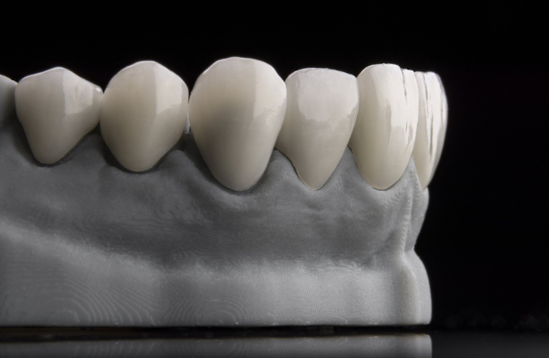 Ceramic dental veneers on artificial plastic jaw — Madison, WI — East Grove Dental Ceramic dental veneers on artificial plastic jaw — Madison, WI — East Grove Dental